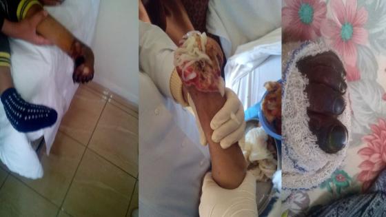 صور وفيديو صادم: مركز حقوقي يكشف فضيحة بطلها طبيب بتر ساق طفل مرتين متتاليتين بمصحة خاصة بمراكش
